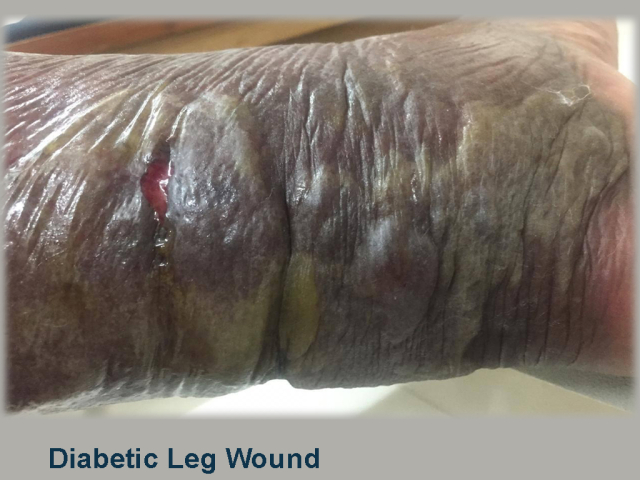 Diabetic Leg Wound