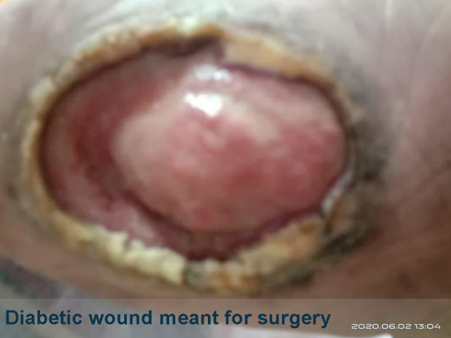 Diabetic Wound