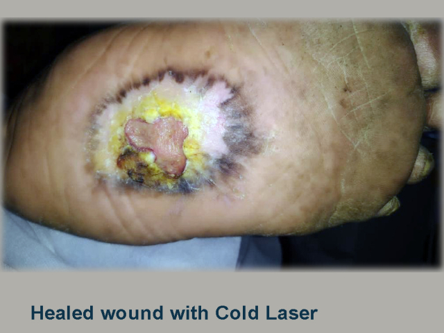 Healed wound with Cold Laser
