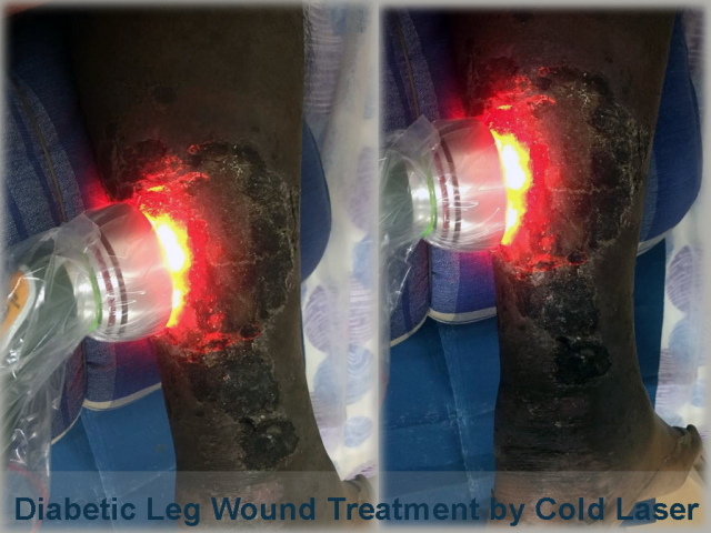 Healing Diabetic Leg Wound with Cold Laser