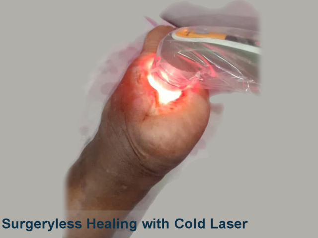 Heal wound using Cold Laser