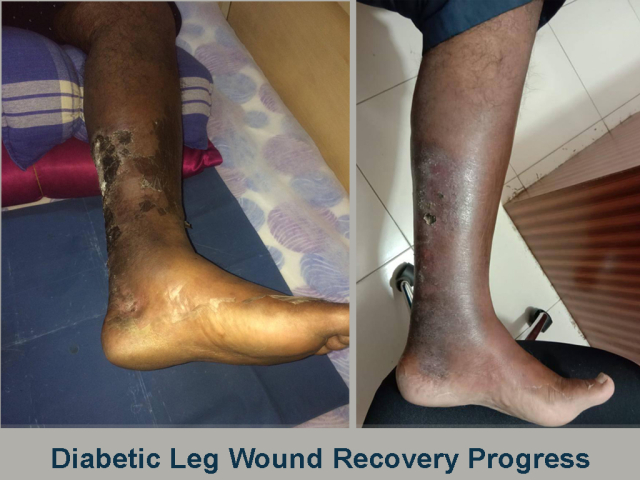 Recovered Diabetic Leg Wound with Cold Laser