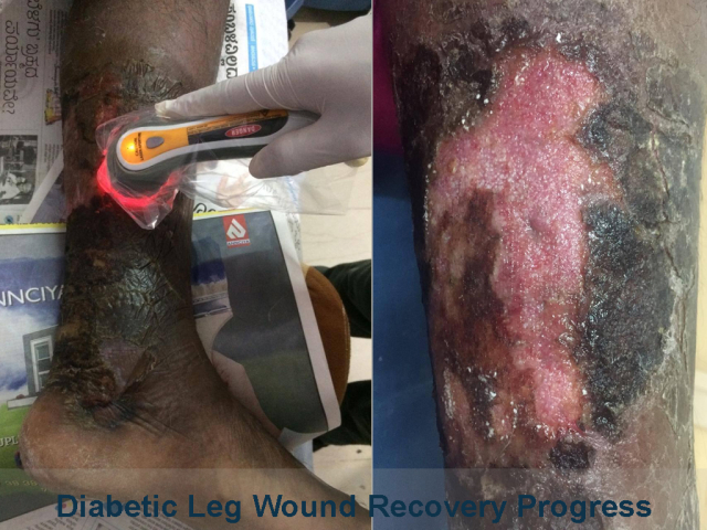 Recovery Diabetic Leg Wound with Cold Laser